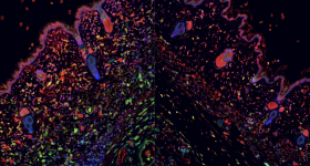  The image shows intense inflammation in an active lesion (left) and easing of that inflammation after treatment (right).