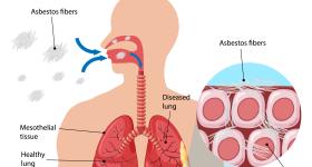 Showing asbestos in lungs