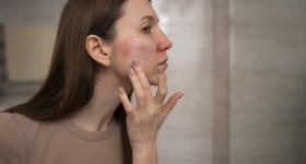 Rosacea